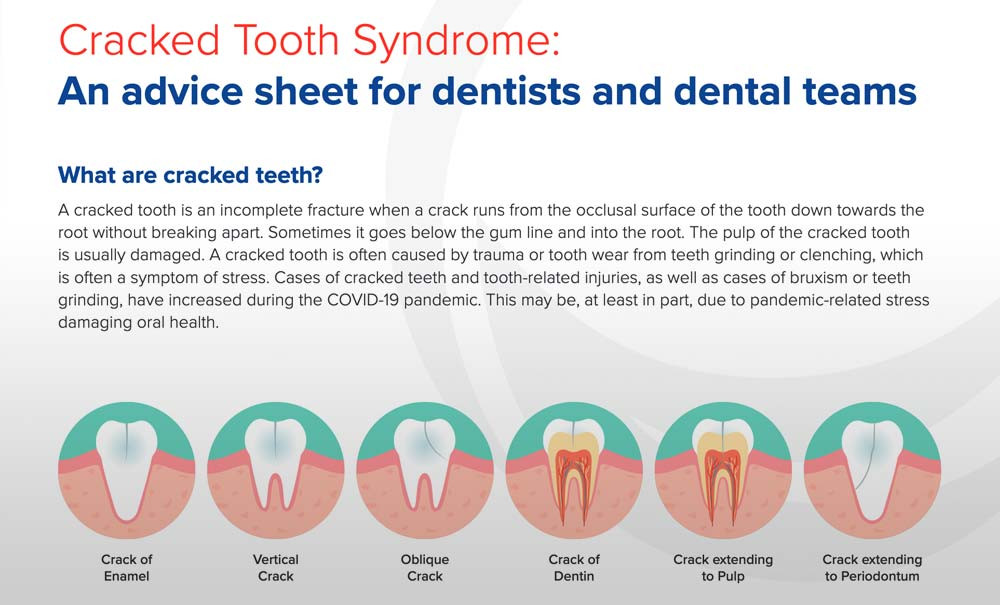 Traiter la dent fêlée L'Information Dentaire