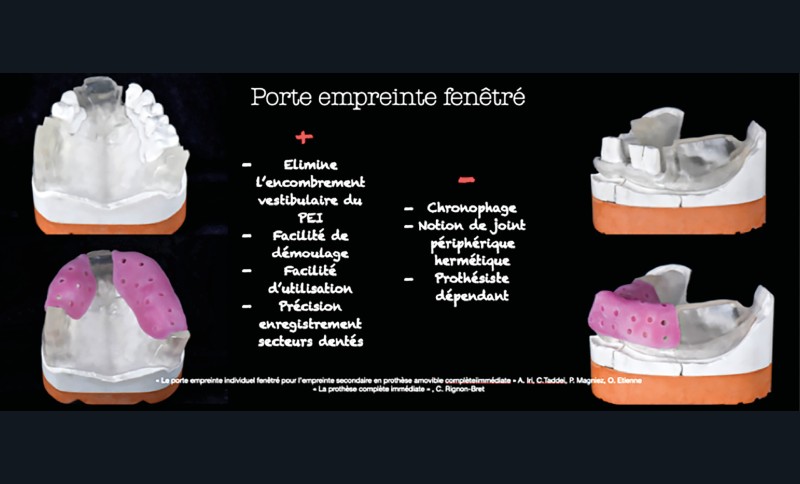 Proth se Compl te Un Travail D quipe L Information Dentaire