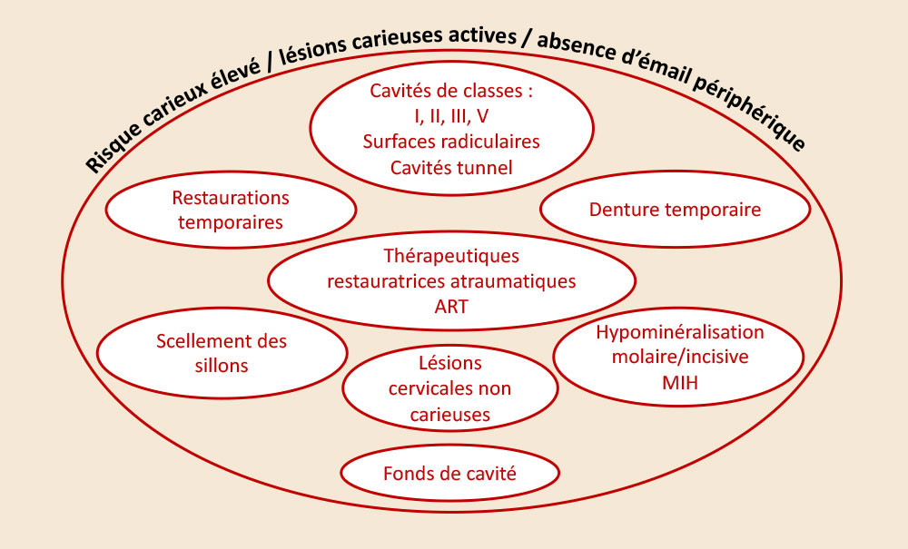 Verres ionomères et prévention carieuse L'Information Dentaire