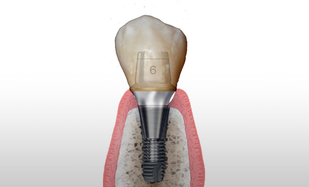 Interface des piliers implantaires et attache gingivale L'Information