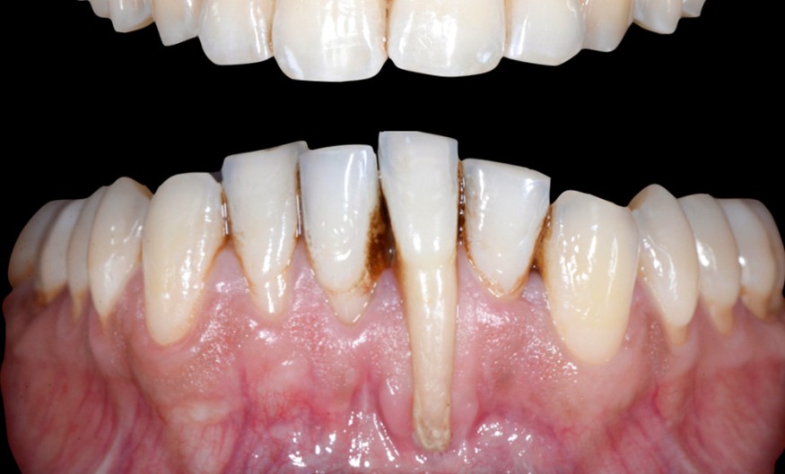 Syndrome Fil Contention Dentaire Le Syndrome Du Fil De Contention, Risques Et Solutions