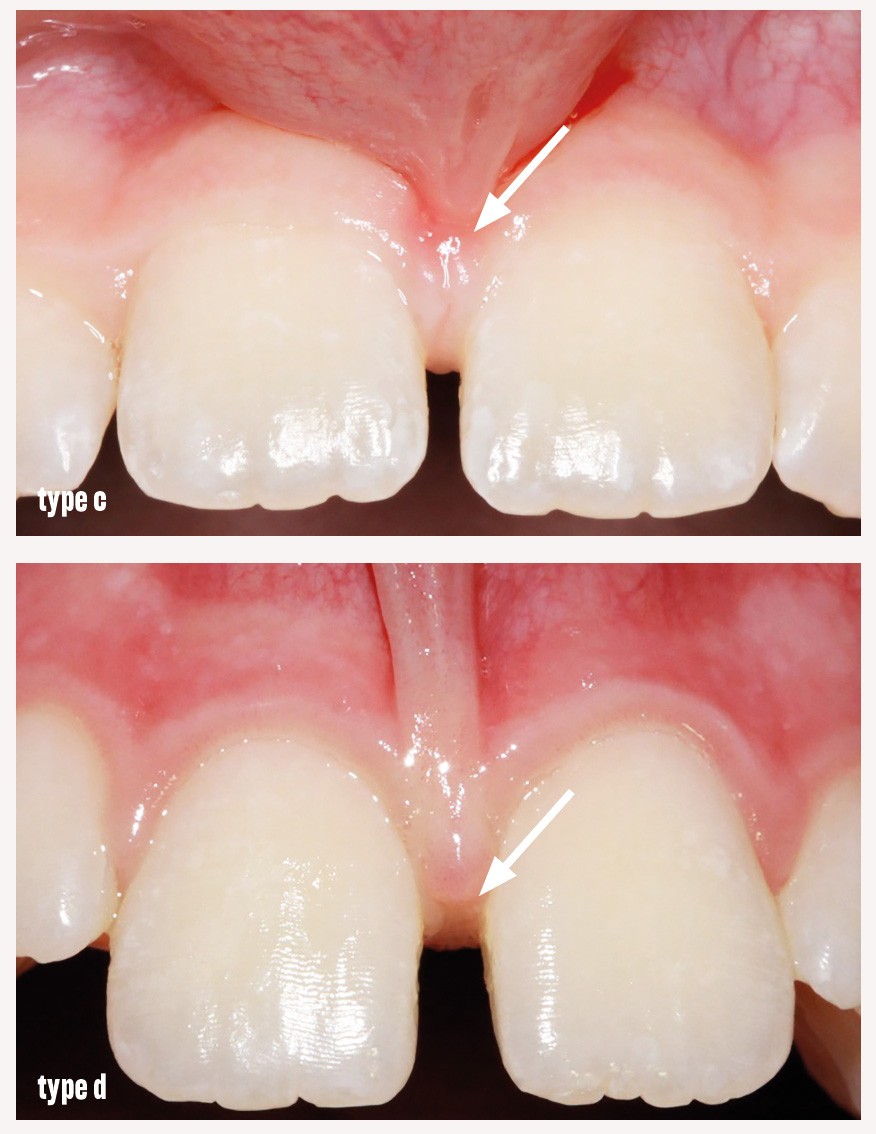 Recharge De Joint Cervical Souple Pour Laboratoire Dentaire - Matériel Dentaire