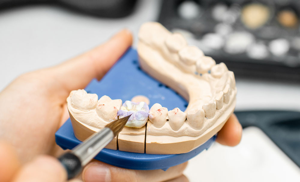 Les prothèses dentaires : responsabilité et garanties pour le laboratoire –  L'Information Dentaire