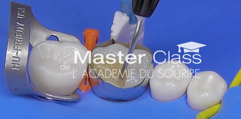Inlays / onlays & le collage au quotidien – L'Information Dentaire