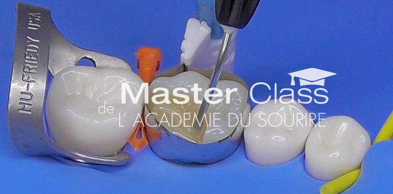 Inlays / onlays & le collage au quotidien – L'Information Dentaire