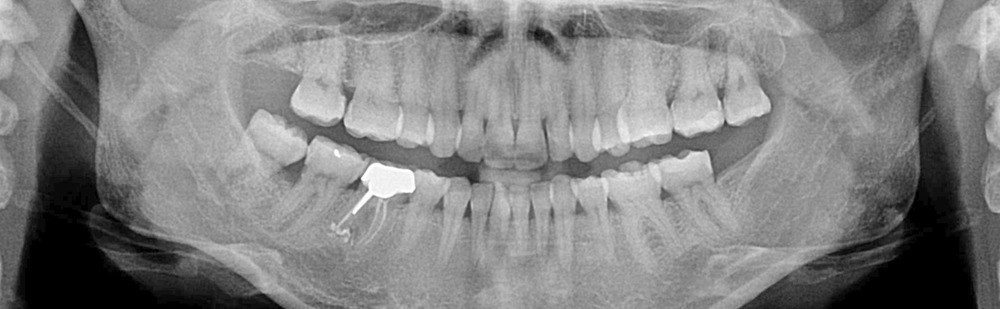Recul maxillaire sur mini-vis d'ancrage mandibulaire après réévaluation  thérapeutique – L'Information Dentaire
