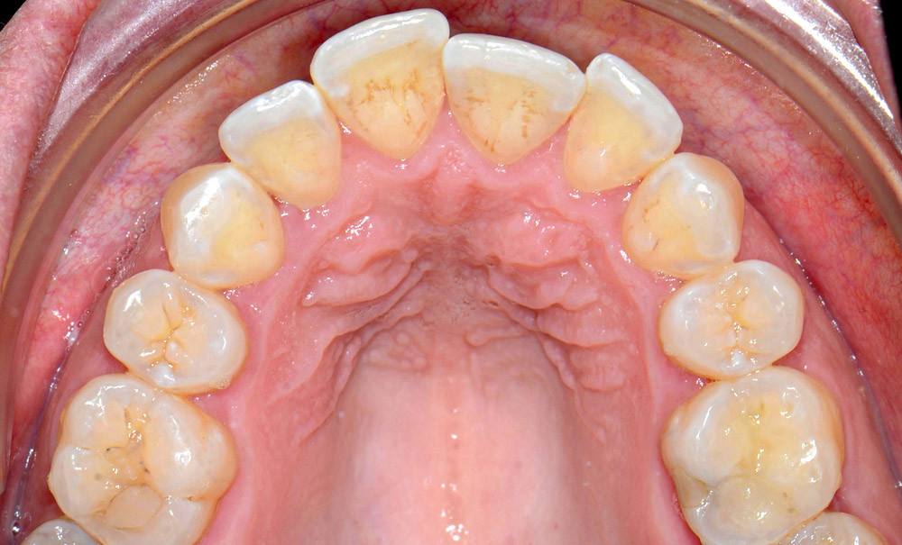 Recul maxillaire sur mini-vis d'ancrage mandibulaire après réévaluation  thérapeutique – L'Information Dentaire