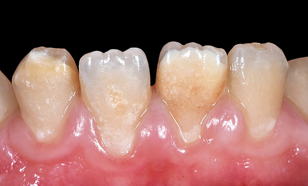 Les hypominéralisations molaires incisives (MIH) Partie 2 Identifier les aspects cliniques