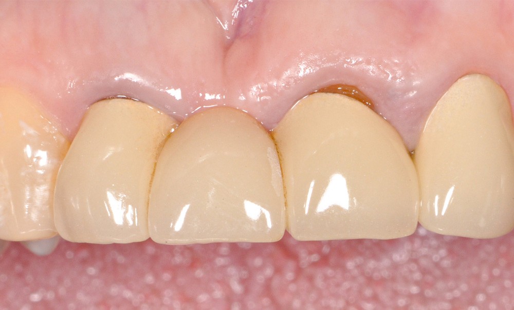 Bridge collé cantilever vs Implant unitaire : analyse décisionnelle ...