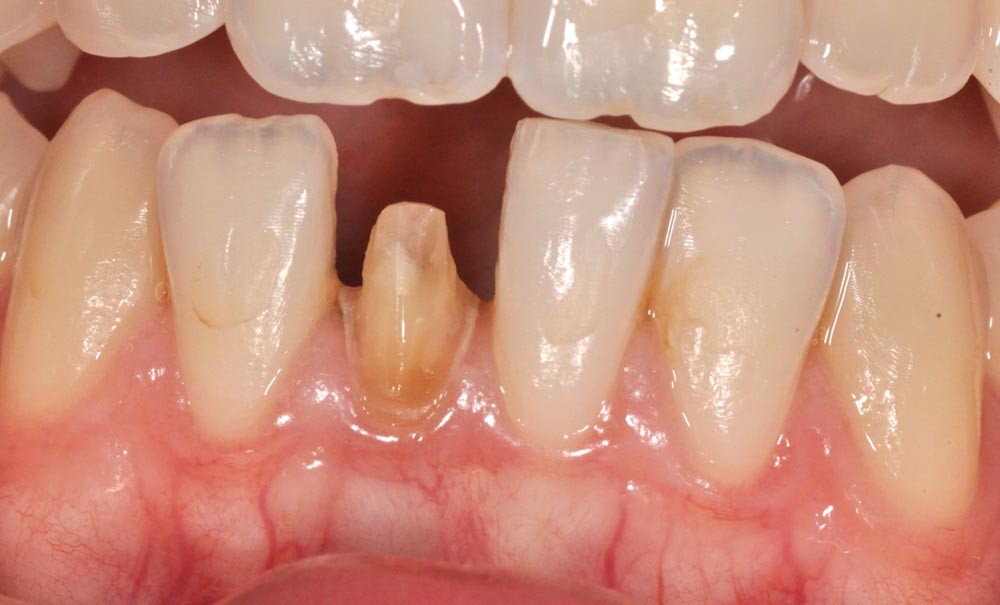 L’inlay-core soumis au principe de la dentisterie fondée sur les ...
