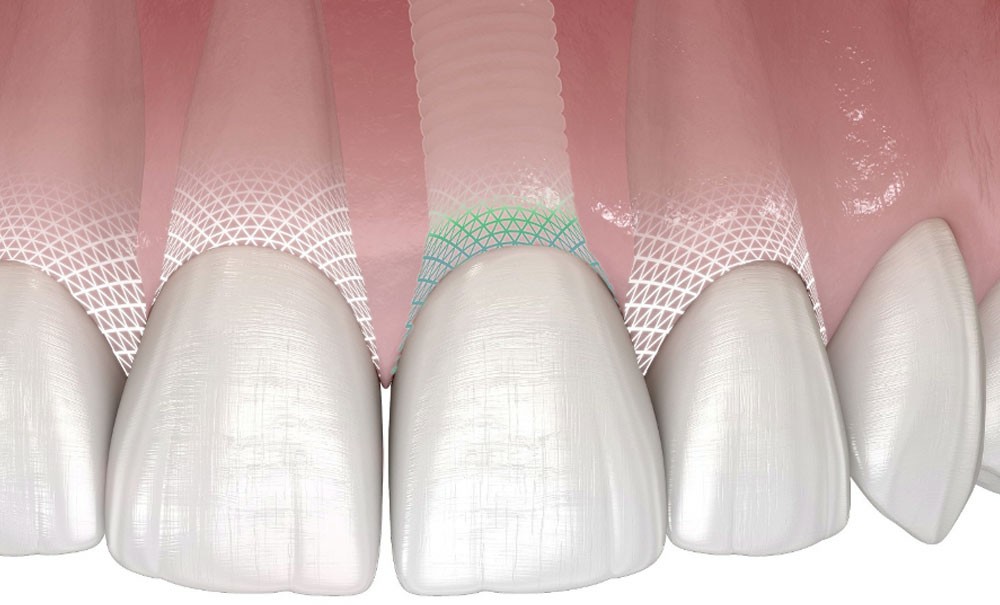 Symbionic Teeth, de Patent – L'Information Dentaire