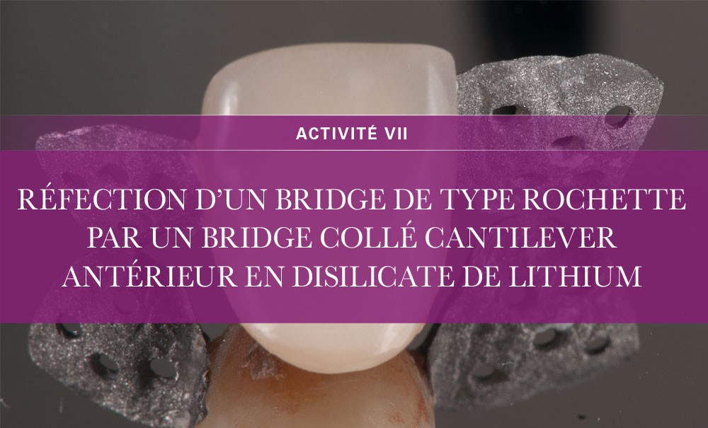 Réfection d’un bridge de type Rochette par un bridge collé cantilever ...