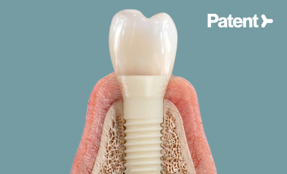 Implants dentaires ?Symbionic Teeth est le remplacement dentaire de ...