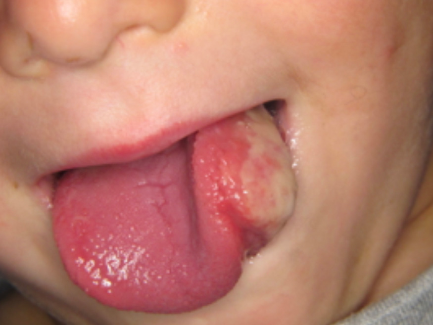 Tumeurs de la petite enfance – L'Information Dentaire